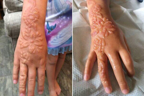 Tatuagem de henna gera cicatrizes permanentes em menina de